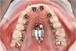 Surgically-Assisted Palatal Expander