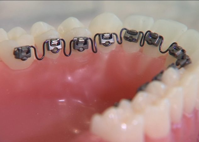 Teeth model with InBrace installed on the back of the teeth.