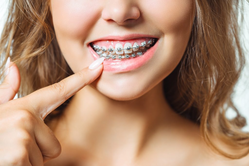 Orthodontic Treatment. Dental Care Concept.