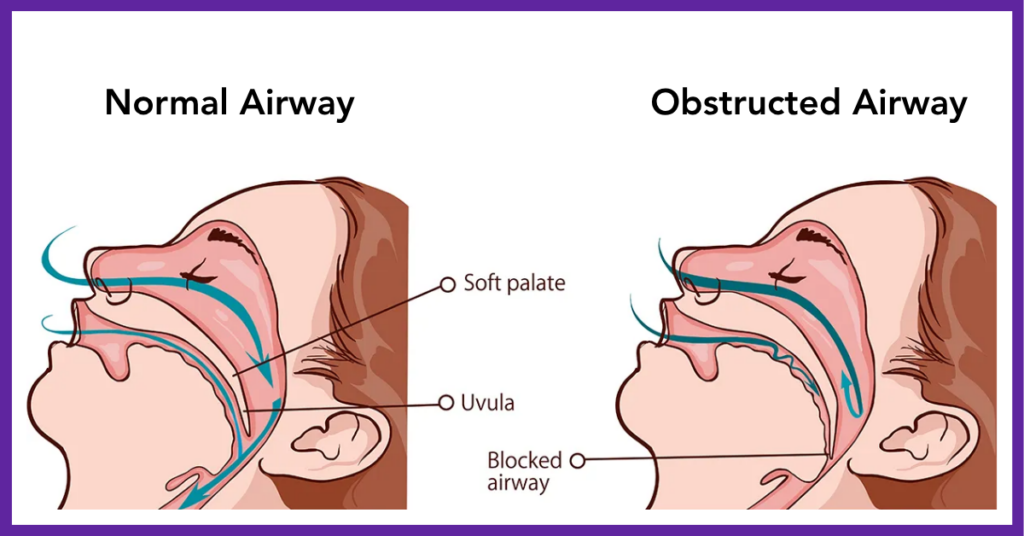Comparison of a Normal Airway versus an Obstructed Airway. The illustration shows how air may be constricted while sleeping.