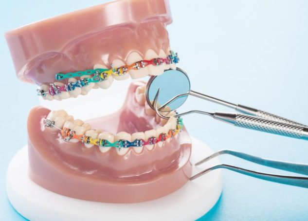 Dental Tooth Model with braces and temporary anchorage devices.