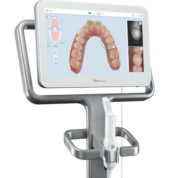 3-D Itero Orthodontic Scanner