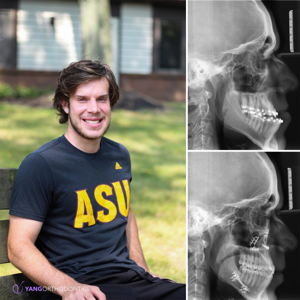 Patient is shown smiling next to his cephalometric x-rays of before and after treatment. The lower jaw is visibly moved back and the severe underbite is corrected.