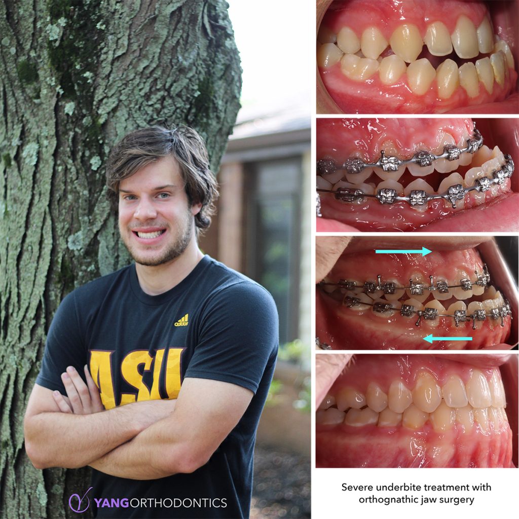 One of our patients at Yang Orthodontics had a severe underbite corrected with braces and orthognathic jaw surgery to move the lower jaw back. Patient is shown smiling alongside his case’s before and after photos with and without braces.
