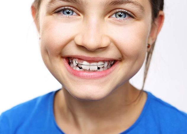 Smiling child with Phase 1 orthodontic treatment.