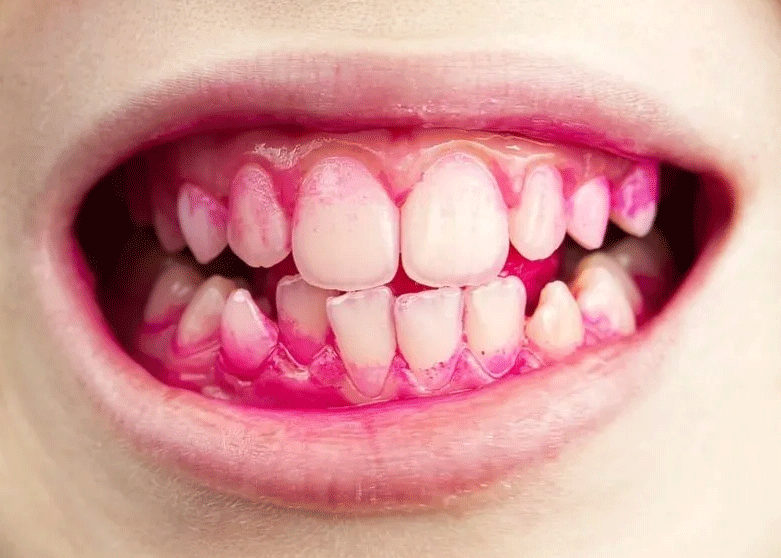 Chewing a disclosing tablet reveals plaque to be easily cleaned