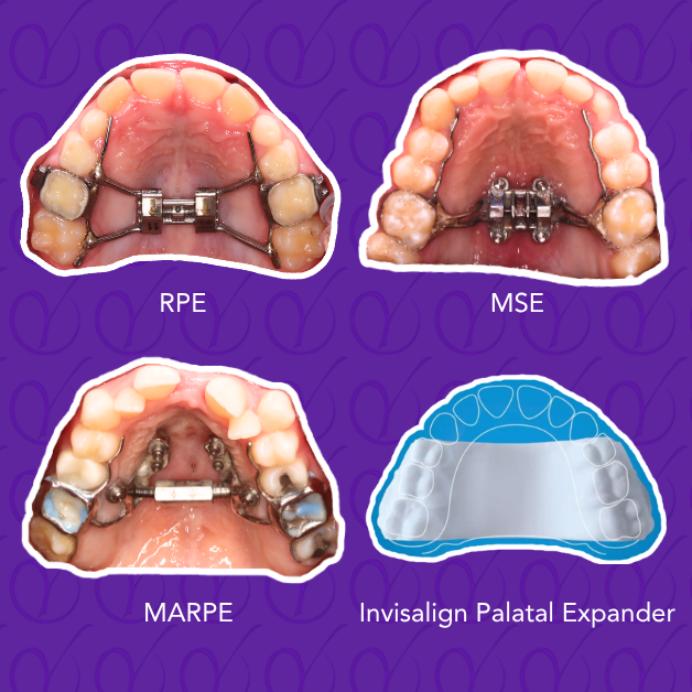 Type of Expanders. Expanders such as RPE, MSE, MARPE, and Invisalign Palatal Expander may lesson obstructed airway symptoms. Particularly if you have Sleep Apnea or Sleep Disordered Breathing 