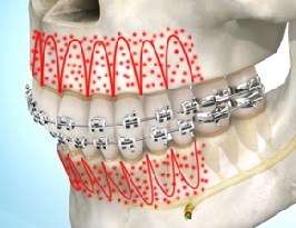 Periodontal Accelerated Osteogenic Orthodontics