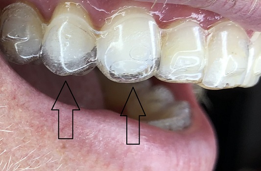 Aligners may not fit the teeth for a number of reasons.