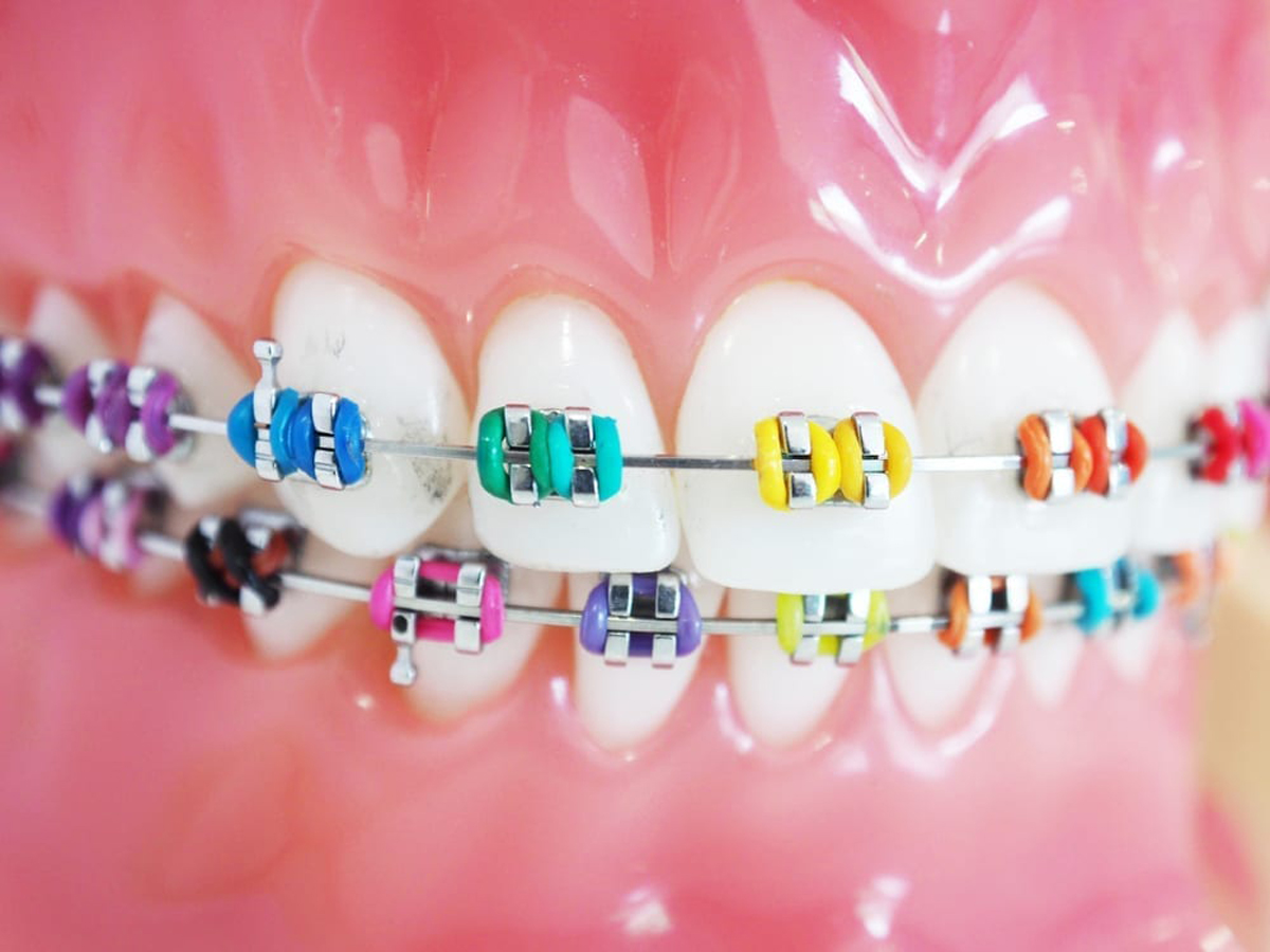 orthodontist braces colors wheel