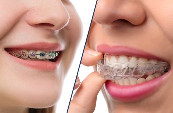 Braces and Invisalign side by side