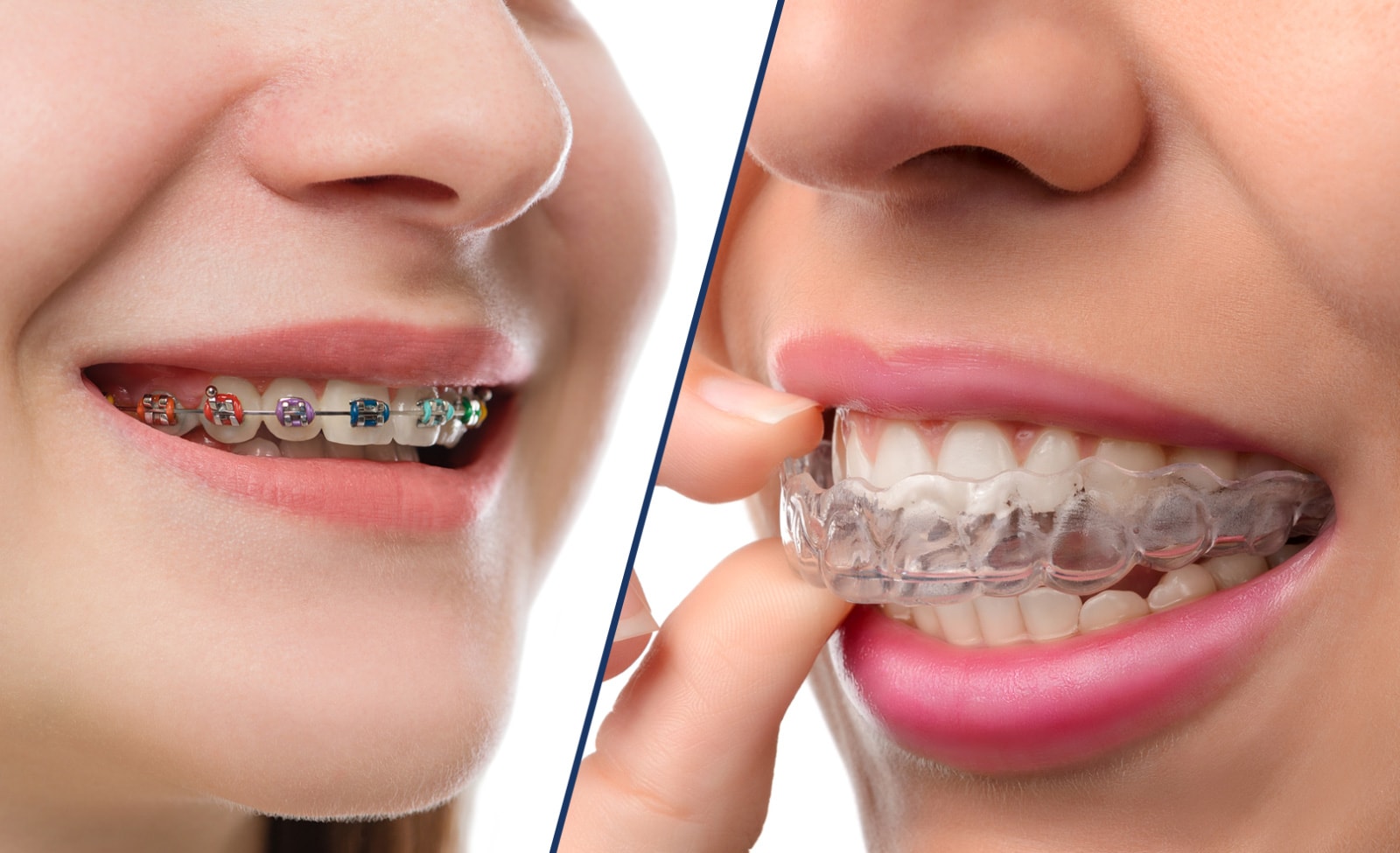 Braces and Invisalign side by side
