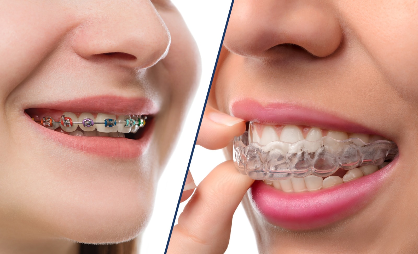 invisible braces with color