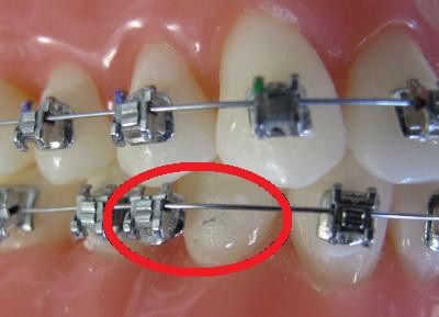 Help! My braces are broken. - Mehta Orthodontics