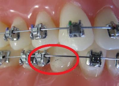 Orthodontic Emergencies: What to Do When a Bracket Breaks or Wire