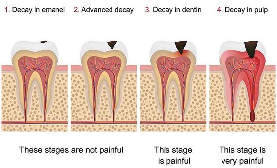 cavity progression