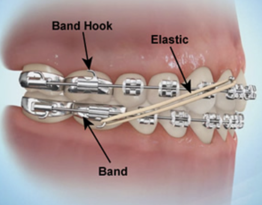 elastics attached to braces.