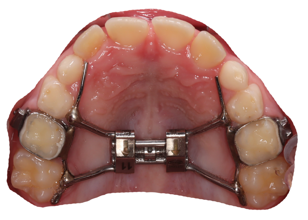 The roof of a patient’s mouth is shown with a rapid palatal expander cemented in. 