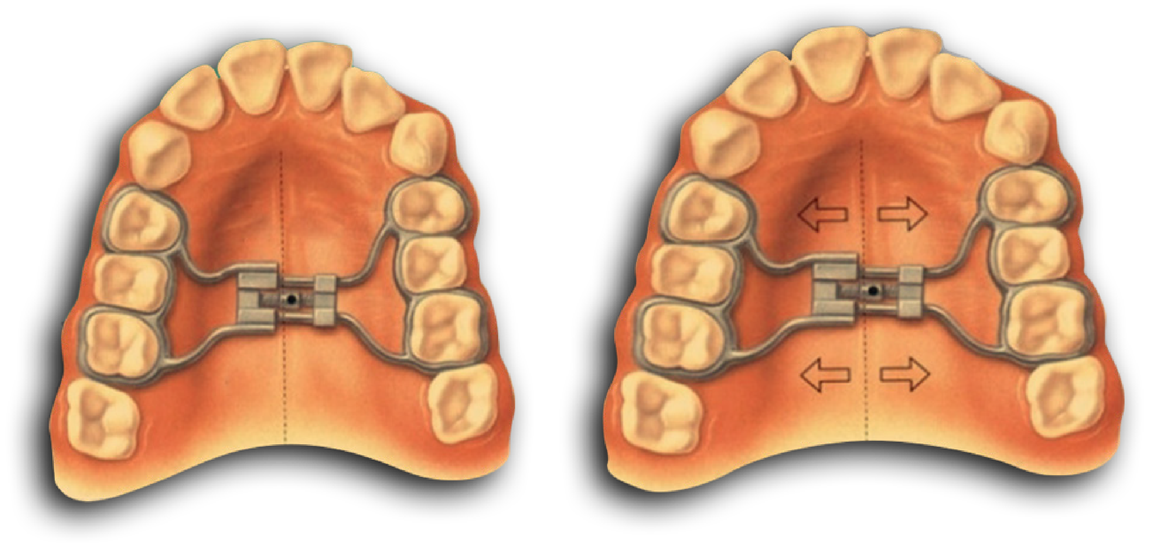 A Rapid Palatal Expander is shown expanding the width of the upper palate.