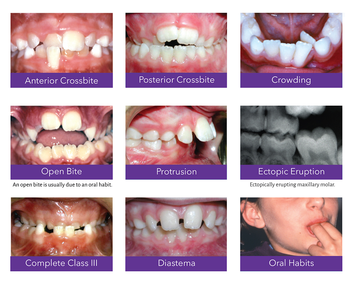 Invisalign First - Yang Orthodontics