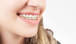 Person smiling with gold braces.