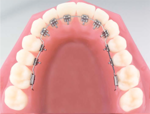 Lingual braces on tooth model