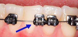 A braces bracket is loose but still on the wire with the tie wire intact. The tie wire is the band that keeps the bracket attached to the wire.