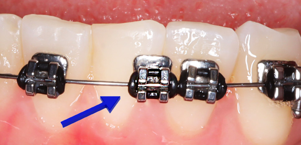 My Wire Came Loose and is Poking, What Do I Do? - Ask an Orthodontist.com