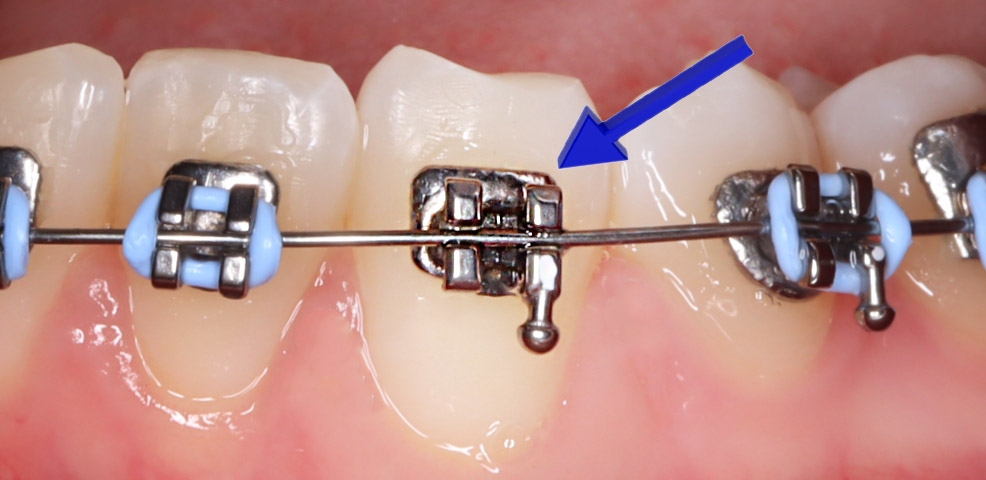 A braces bracket is missing a tie wire. The tie wire is the band that keeps the bracket attached to the wire.