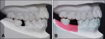 Adjunctive orthodontic treatment is used to assist in making proper space for replacement teeth.