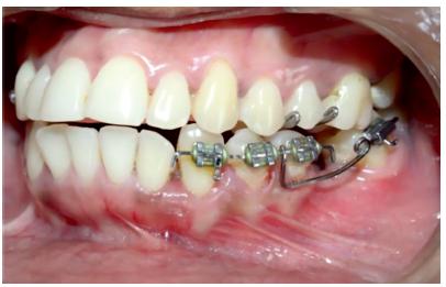 Limited brackets are placed on the lower arch to upright the lower left second molar in preparation for lower first molar dental implant.