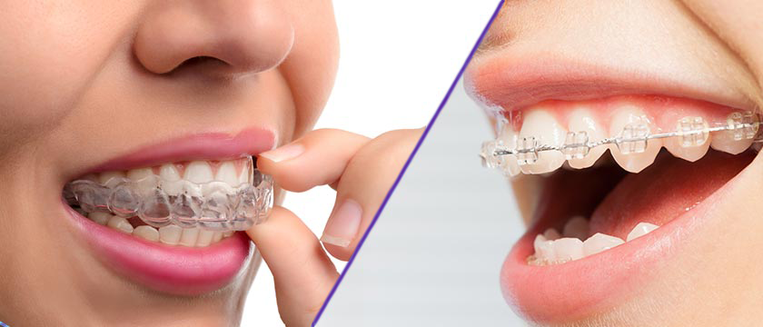 image of teeth with invisalign contrasted next to teeth with braces