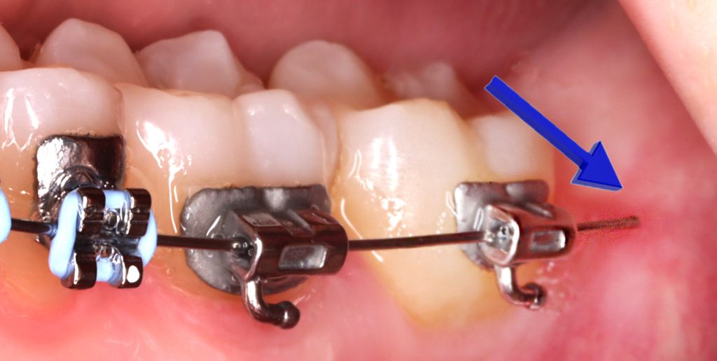 An archwire for braces is sticking out past the end tube bracket and poking the inside of the mouth.