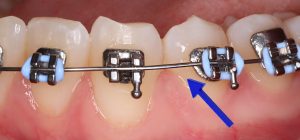 A braces archwire has slid out of a bracket.