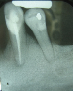 crowding teeth x-ray
