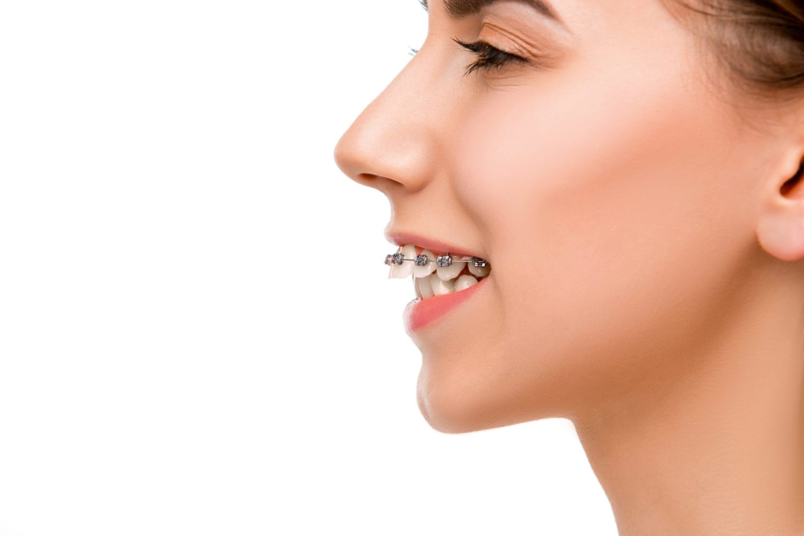 Overbite Correction, No Braces or Invisalign®, No Surgery in 8